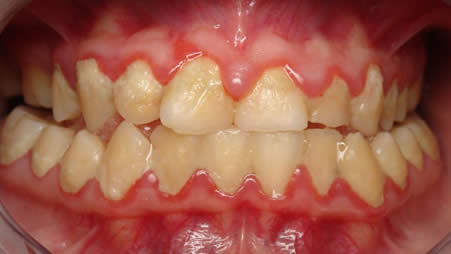 Gum Disease Treatment St Helens at Corner Dental Surgery